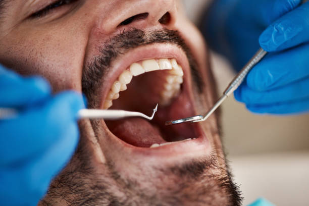 Best Emergency Dentist for Lost Fillings or Crowns in Everett, PA
